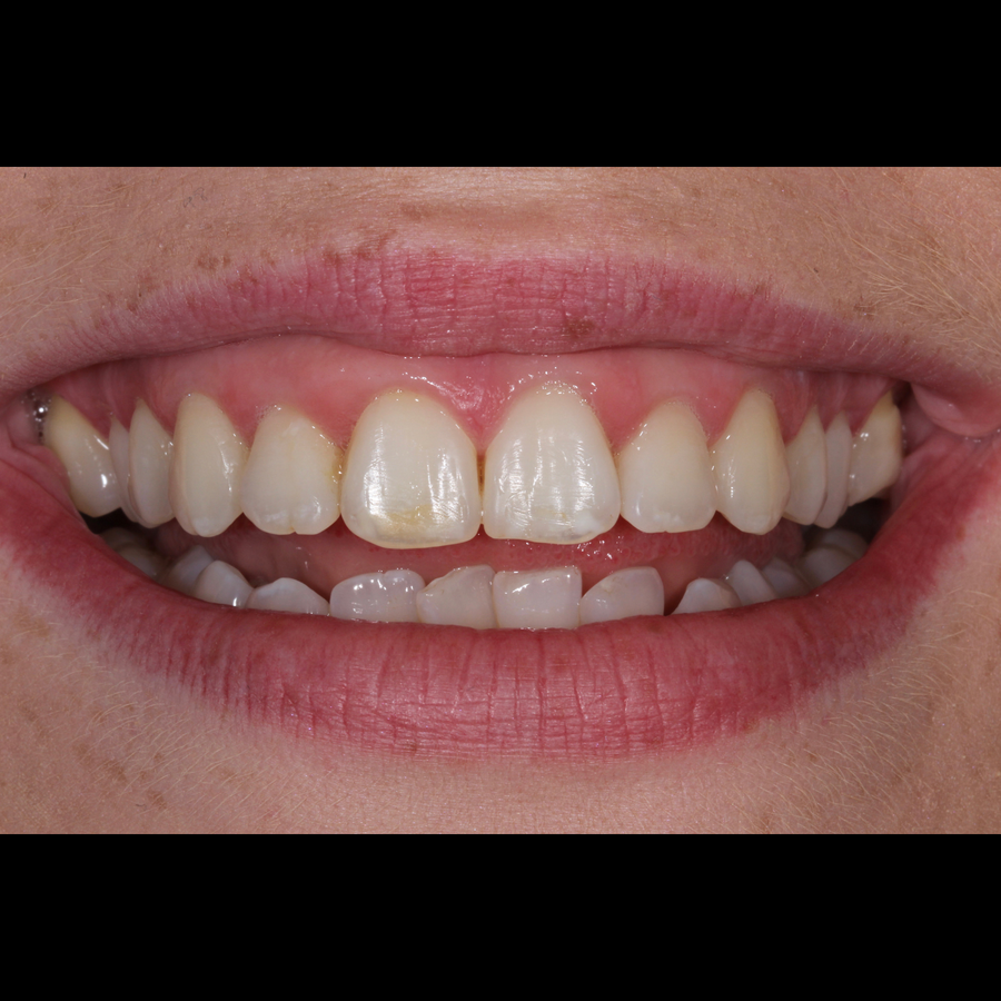 How 6 month braces work - Tara - after - 3Dental